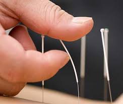 toptan akupunktur iğnesi
